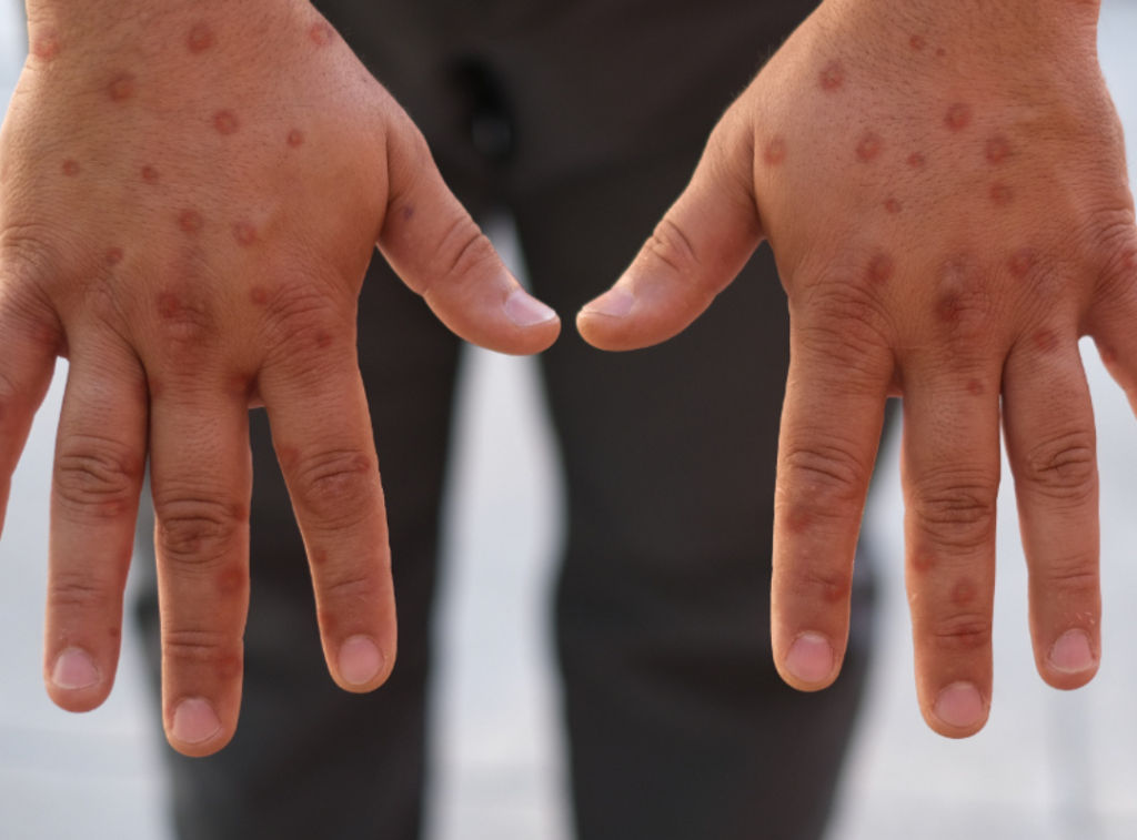 Natal reforça cuidados após primeiro caso de Mpox de 2026